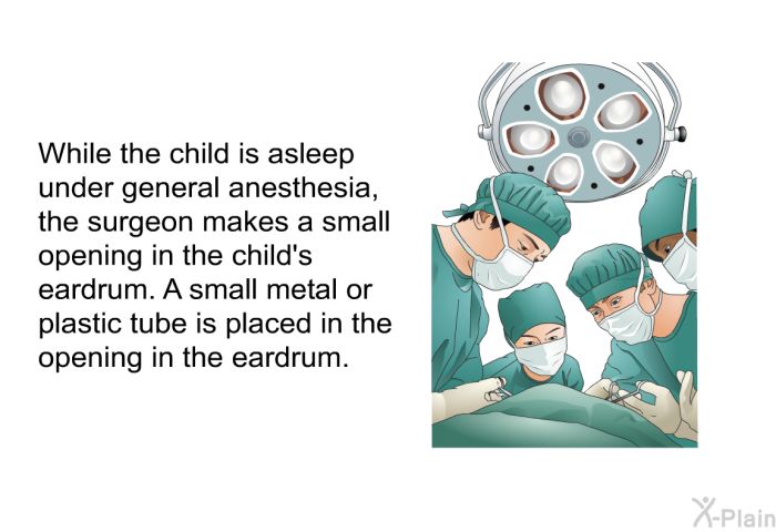 While the child is asleep under general anesthesia, the surgeon makes a small opening in the child's eardrum. A small metal or plastic tube is placed in the opening in the eardrum.