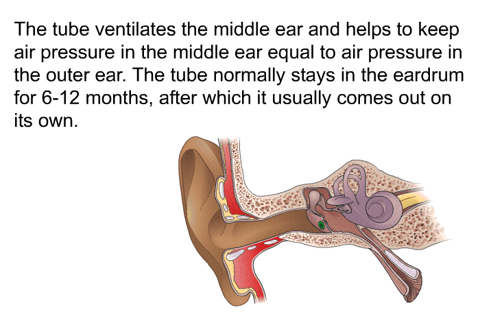The tube ventilates the middle ear and helps to keep air pressure in the middle ear equal to air pressure in the outer ear. The tube normally stays in the eardrum for 6-12 months, after which it usually comes out on its own.