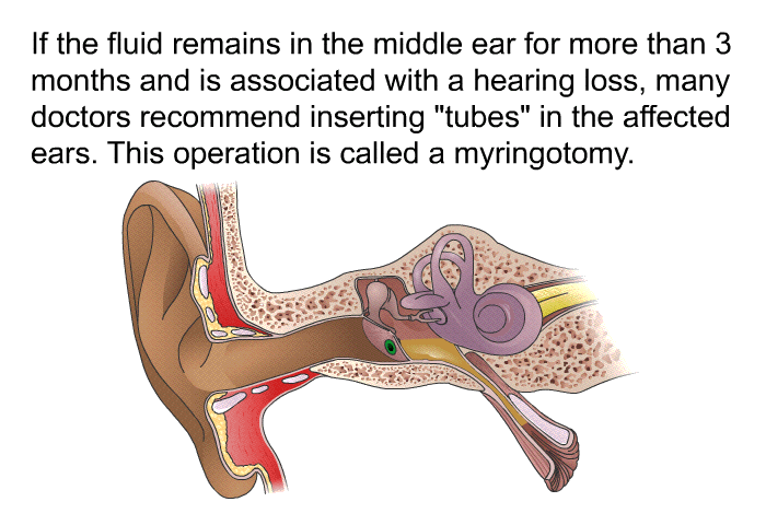 If the fluid remains in the middle ear for more than 3 months and is associated with a hearing loss, many doctors recommend inserting "tubes" in the affected ears. This operation is called a myringotomy.