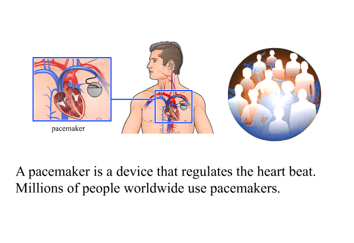A pacemaker is a device that regulates the heart beat. Millions of people worldwide use pacemakers.