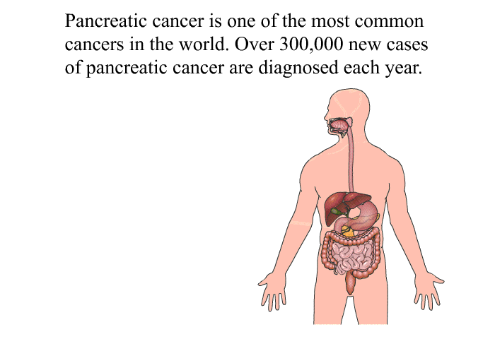Pancreatic cancer is one of the most common cancers in the world. Over 300,000 new cases of pancreatic cancer are diagnosed each year.