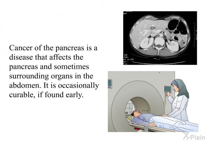 Cancer of the pancreas is a disease that affects the pancreas and sometimes surrounding organs in the abdomen. It is occasionally curable, if found early.