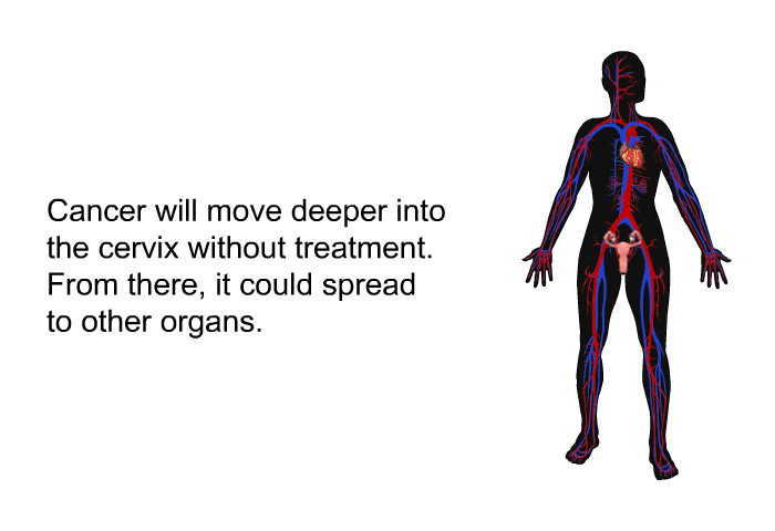 Cancer will move deeper into the cervix without treatment. From there, it could spread to other organs.