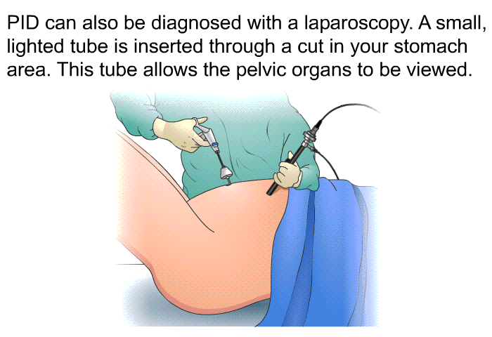 PID can also be diagnosed with a laparoscopy. A small, lighted tube is inserted through a cut in your stomach area. This tube allows the pelvic organs to be viewed.