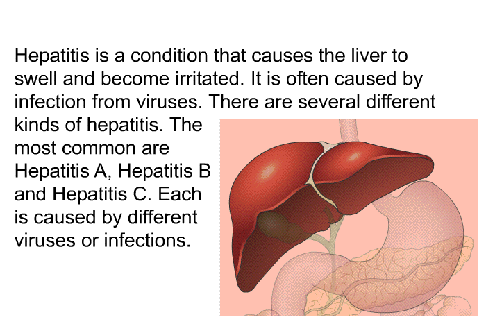 Hepatitis is a condition that causes the liver to swell and become irritated. It is often caused by infection from viruses. There are several different kinds of hepatitis. The most common are Hepatitis A, Hepatitis B and Hepatitis C. Each is caused by different viruses or infections.
