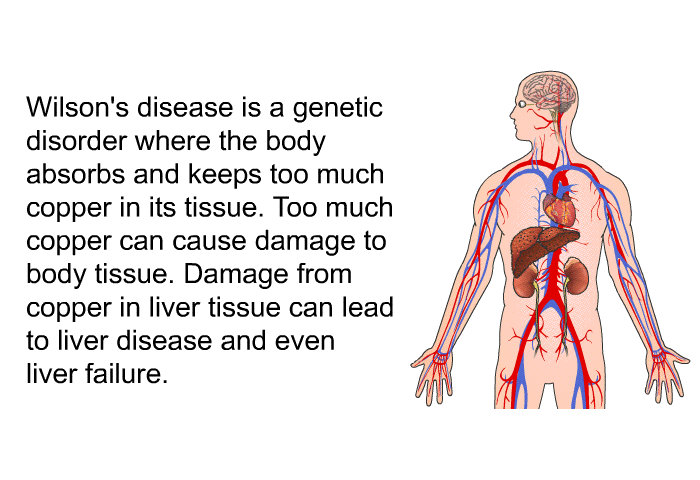 Wilson's disease is a genetic disorder where the body absorbs and keeps too much copper in its tissue. Too much copper can cause damage to body tissue. Damage from copper in liver tissue can lead to liver disease and even liver failure.