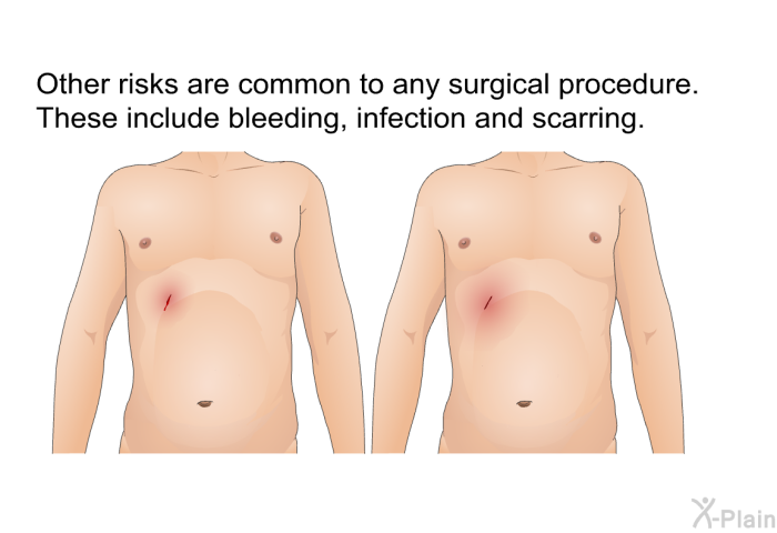 Other risks are common to any surgical procedure. These include bleeding, infection and scarring.