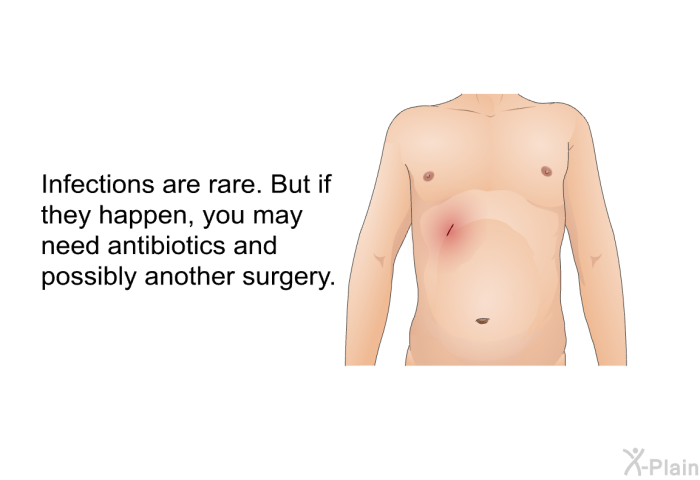 Infections are rare. But if they happen, you may need antibiotics and possibly another surgery.
