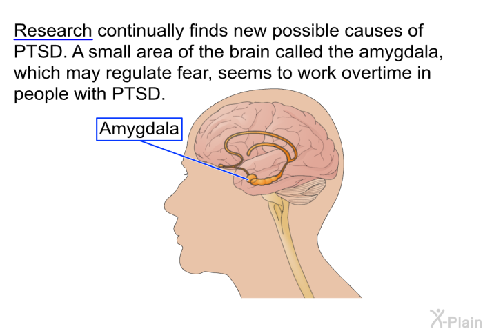 Research continually finds new possible causes of PTSD. A small area of the brain called the amygdala, which may regulate fear, seems to work overtime in people with PTSD.