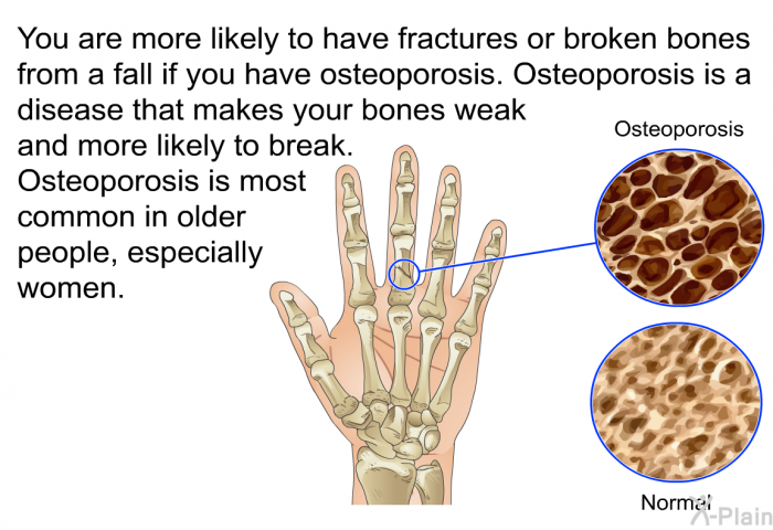 You are more likely to have fractures or broken bones from a fall if you have osteoporosis. Osteoporosis is a disease that makes your bones weak and more likely to break. Osteoporosis is most common in older people, especially women.