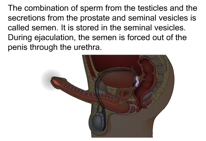 The combination of sperm from the testicles and the secretions from the prostate and seminal vesicles is called semen. It is stored in the seminal vesicles. During ejaculation, the semen is forced out of the penis through the urethra.