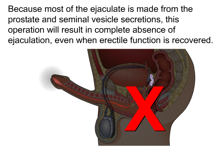 Because most of the ejaculate is made from the prostate and seminal vesicle secretions, this operation will result in complete absence of ejaculation, even when erectile function is recovered.