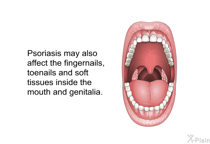 Psoriasis may also affect the fingernails, toenails and soft tissues inside the mouth and genitalia.