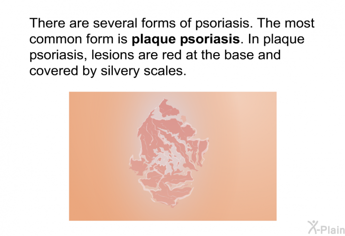 There are several forms of psoriasis. The most common form is <I><B>plaque psoriasis</B></I>. In plaque psoriasis, lesions are red at the base and covered by silvery scales.