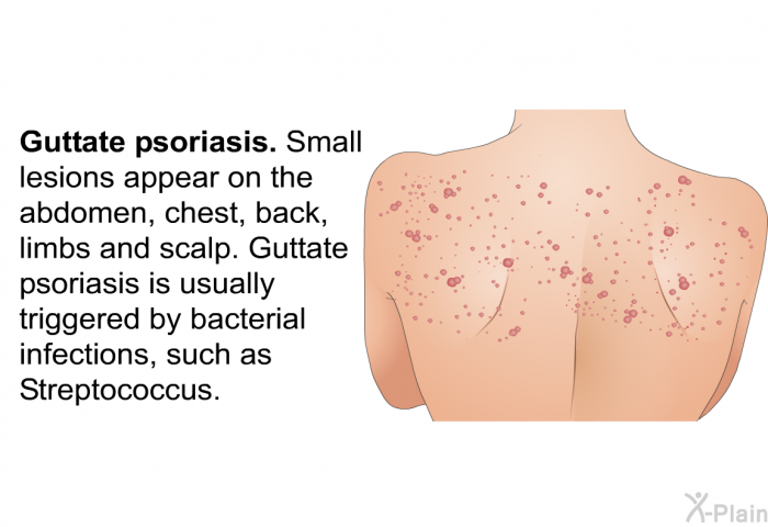 <I><B>Guttate psoriasis</B></I>. Small lesions appear on the abdomen, chest, back, limbs and scalp. Guttate psoriasis is usually triggered by bacterial infections, such as <I>Streptococcus</I> .