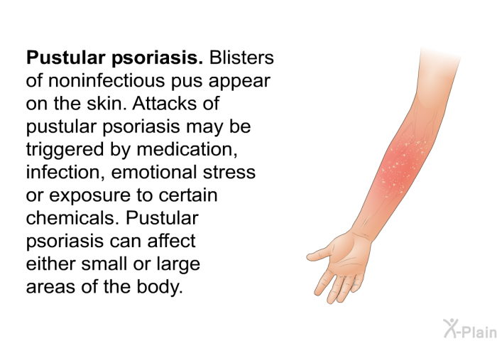 <I><B>Pustular psoriasis</B></I>. Blisters of noninfectious pus appear on the skin. Attacks of pustular psoriasis may be triggered by medication, infection, emotional stress or exposure to certain chemicals. Pustular psoriasis can affect either small or large areas of the body.