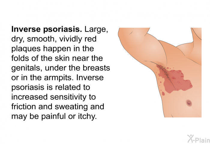 <I><B>Inverse psoriasis</B></I>. Large, dry, smooth, vividly red plaques happen in the folds of the skin near the genitals, under the breasts or in the armpits. Inverse psoriasis is related to increased sensitivity to friction and sweating and may be painful or itchy.
