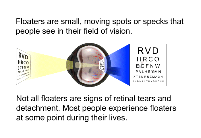 Floaters are small, moving spots or specks that people see in their field of vision. Not all floaters are signs of retinal tears and detachment. Most people experience floaters at some point during their lives.