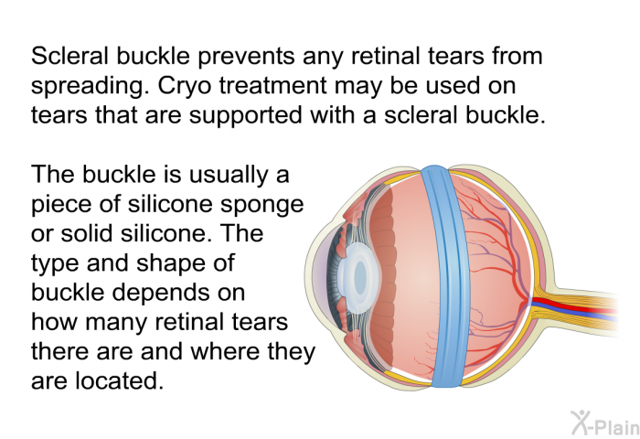 Scleral buckle prevents any retinal tears from spreading. Cryo treatment may be used on tears that are supported with a scleral buckle. The buckle is usually a piece of silicone sponge or solid silicone. The type and shape of buckle depends on how many retinal tears there are and where they are located.