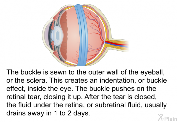 The buckle is sewn to the outer wall of the eyeball, or the sclera. This creates an indentation, or buckle effect, inside the eye. The buckle pushes on the retinal tear, closing it up. After the tear is closed, the fluid under the retina, or subretinal fluid, usually drains away in 1 to 2 days.