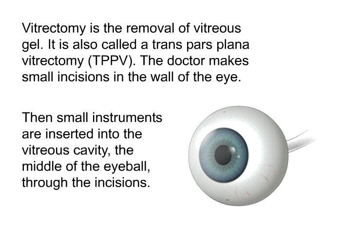 Vitrectomy is the removal of vitreous gel. It is also called a trans pars plana vitrectomy (TPPV). The doctor makes small incisions in the wall of the eye. Then small instruments are inserted into the vitreous cavity, the middle of the eyeball, through the incisions.
