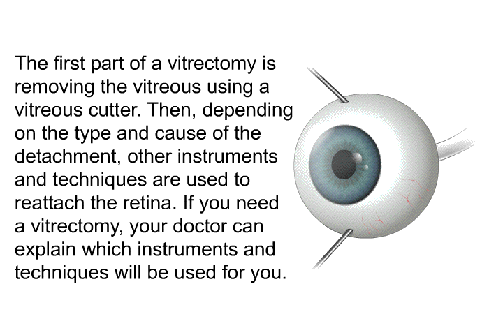 The first part of a vitrectomy is removing the vitreous using a vitreous cutter. Then, depending on the type and cause of the detachment, other instruments and techniques are used to reattach the retina. If you need a vitrectomy, your doctor can explain which instruments and techniques will be used for you.