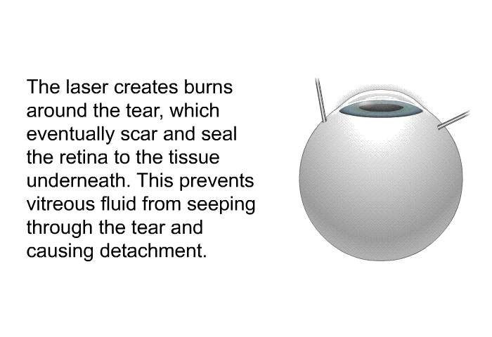 The laser creates burns around the tear, which eventually scar and seal the retina to the tissue underneath. This prevents vitreous fluid from seeping through the tear and causing detachment.