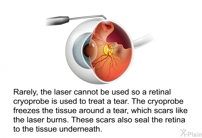 Rarely, the laser cannot be used so a retinal cryoprobe is used to treat a tear. The cryoprobe freezes the tissue around a tear, which scars like the laser burns. These scars also seal the retina to the tissue underneath.
