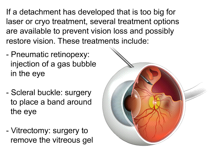 If a detachment has developed that is too big for laser or cryo treatment, several treatment options are available to prevent vision loss and possibly restore vision. These treatments include  Pneumatic retinopexy: injection of a gas bubble in the eye Scleral buckle: surgery to place a band around the eye Vitrectomy: surgery to remove the vitreous gel