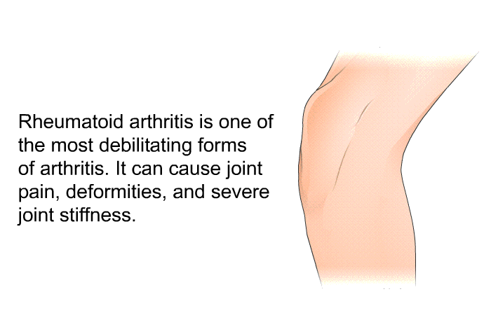 Rheumatoid arthritis is one of the most debilitating forms of arthritis. It can cause joint pain, deformities, and severe joint stiffness.