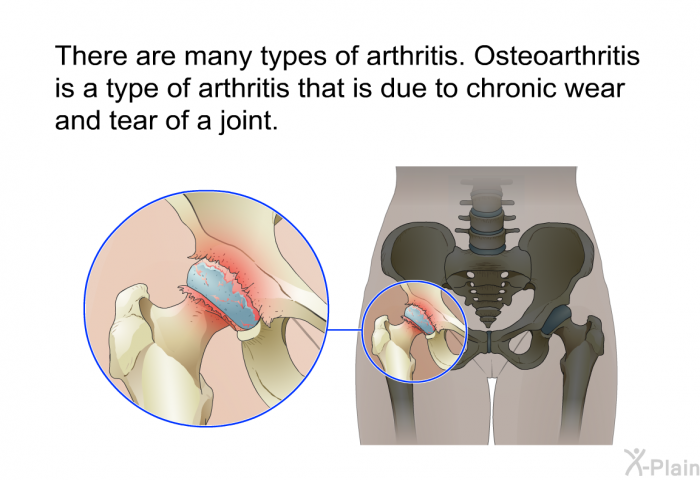 There are many types of arthritis. Osteoarthritis is a type of arthritis that is due to chronic wear and tear of a joint.