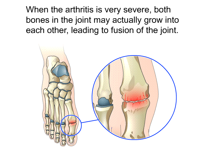 When the arthritis is very severe, both bones in the joint may actually grow into each other, leading to fusion of the joint.