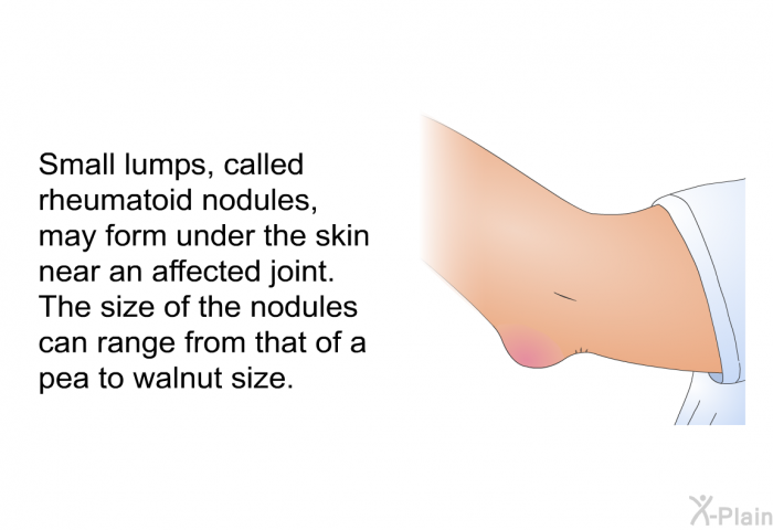 Small lumps, called rheumatoid nodules, may form under the skin near an affected joint. The size of the nodules can range from that of a pea to walnut size.