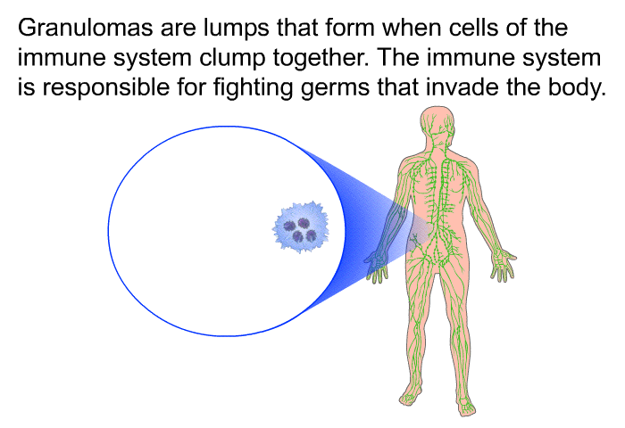 Granulomas are lumps that form when cells of the immune system clump together. The immune system is responsible for fighting germs that invade the body.