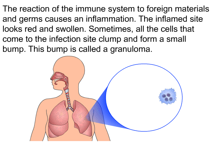 The reaction of the immune system to foreign materials and germs causes an inflammation. The inflamed site looks red and swollen. Sometimes, all the cells that come to the infection site clump and form a small bump. This bump is called a granuloma.