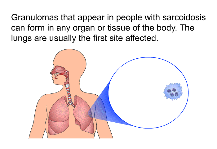Granulomas that appear in people with sarcoidosis can form in any organ or tissue of the body. The lungs are usually the first site affected.