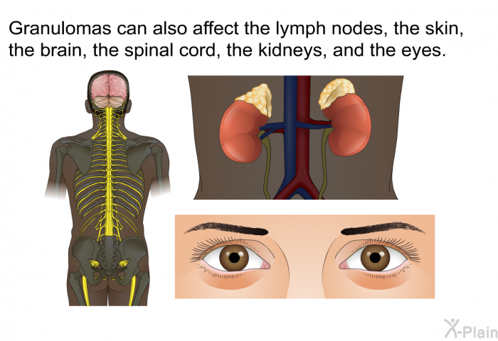 Granulomas can also affect the lymph nodes, the skin, the brain, the spinal cord, the kidneys, and the eyes.