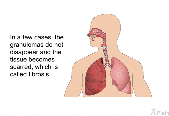 In a few cases, the granulomas do not disappear and the tissue becomes scarred, which is called fibrosis.