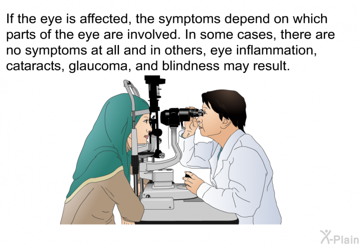 If the eye is affected, the symptoms depend on which parts of the eye are involved. In some cases, there are no symptoms at all and in others, eye inflammation, cataracts, glaucoma, and blindness may result.