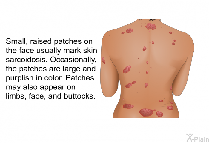 Small, raised patches on the face usually mark skin sarcoidosis. Occasionally, the patches are large and purplish in color. Patches may also appear on limbs, face, and buttocks.