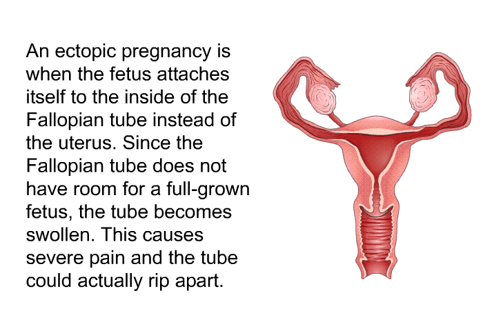 An ectopic pregnancy is when the fetus attaches itself to the inside of the Fallopian tube instead of the uterus. Since the Fallopian tube does not have room for a full-grown fetus, the tube becomes swollen. This causes severe pain and the tube could actually rip apart.