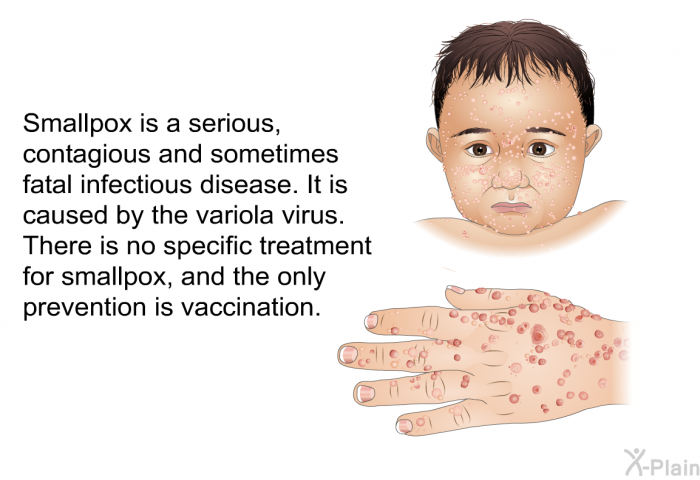 Smallpox is a serious, contagious and sometimes fatal infectious disease. It is caused by the variola virus. There is no specific treatment for smallpox, and the only prevention is vaccination.