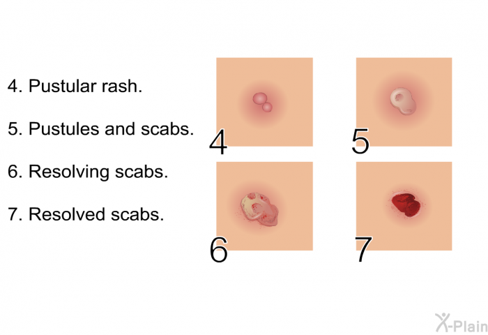 Pustular rash. Pustules and scabs. Resolving scabs. Resolved scabs.