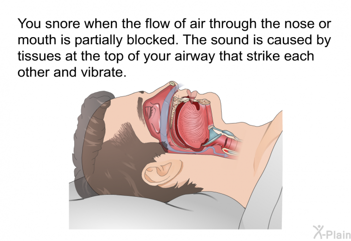 You snore when the flow of air through the nose or mouth is partially blocked. The sound is caused by tissues at the top of your airway that strike each other and vibrate.