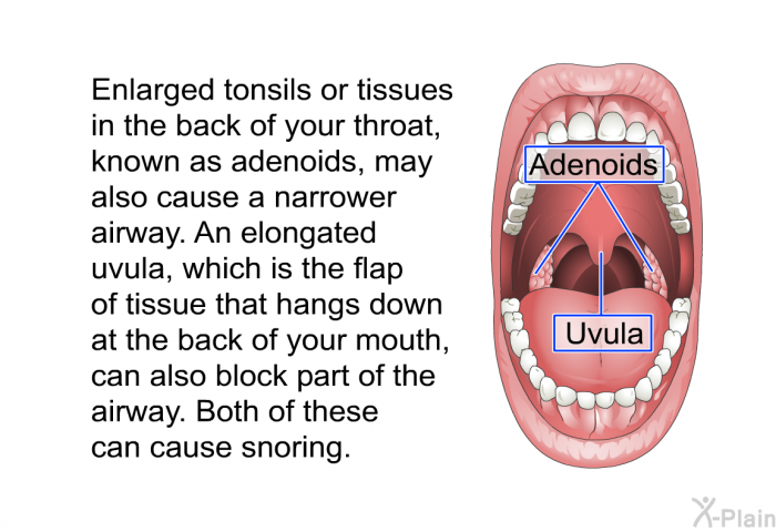Enlarged tonsils or tissues in the back of your throat, known as adenoids, may also cause a narrower airway. An elongated uvula, which is the flap of tissue that hangs down at the back of your mouth, can also block part of the airway. Both of these can cause snoring.