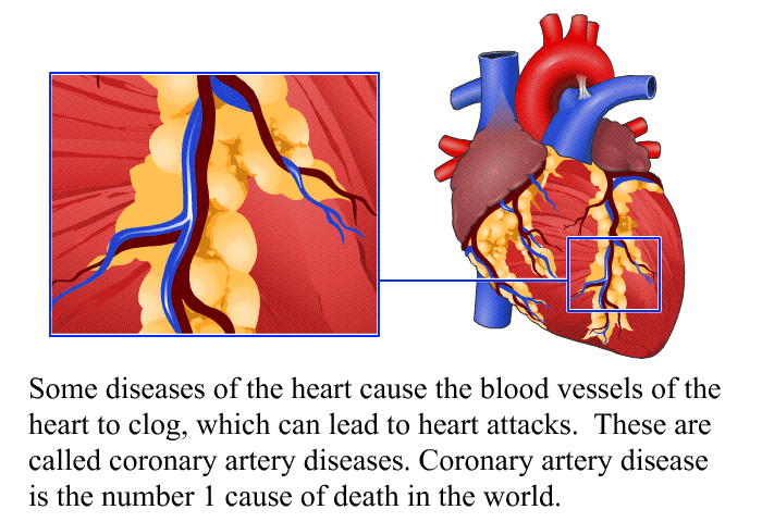 Some diseases of the heart cause the blood vessels of the heart to clog, which can lead to heart attacks. These are called coronary artery diseases. Coronary artery disease is the number 1 cause of death in the world.