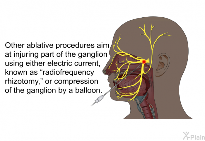 Other ablative procedures aim at injuring part of the ganglion using either electric current, known as “radiofrequency rhizotomy,” or compression of the ganglion by a balloon.