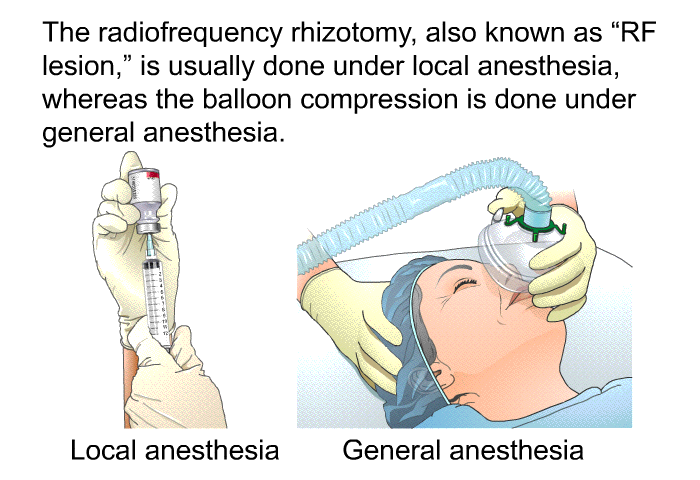 The radiofrequency rhizotomy, also known as “RF lesion,” is usually done under local anesthesia, whereas the balloon compression is done under general anesthesia.