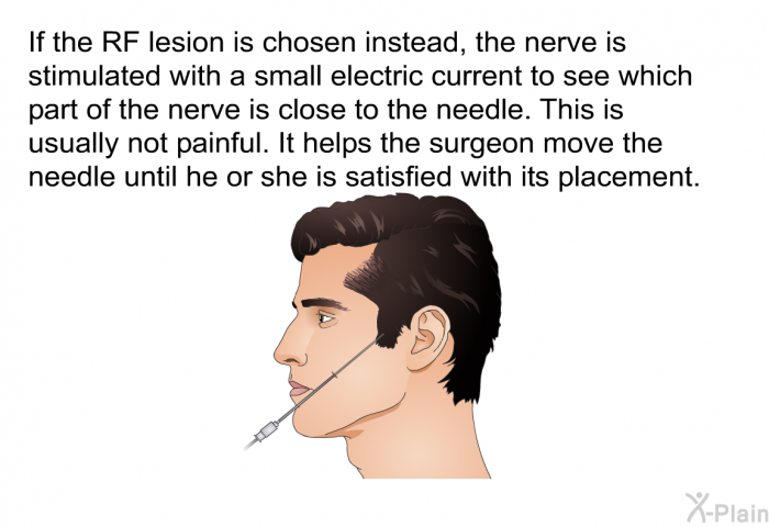 If the RF lesion is chosen instead, the nerve is stimulated with a small electric current to see which part of the nerve is close to the needle. This is usually not painful. It helps the surgeon move the needle until he or she is satisfied with its placement.