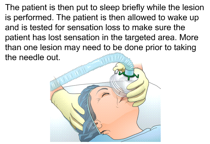 The patient is then put to sleep briefly while the lesion is performed. The patient is then allowed to wake up and is tested for sensation loss to make sure the patient has lost sensation in the targeted area. More than one lesion may need to be done prior to taking the needle out.